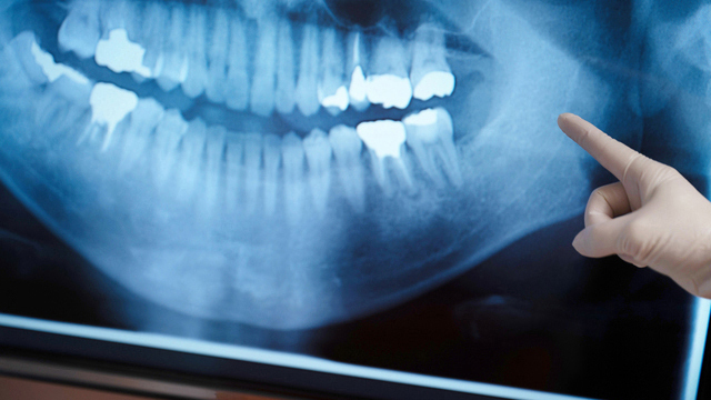 呉市中通の根管治療