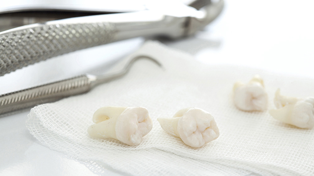 呉市中通の親知らずの抜歯・治療