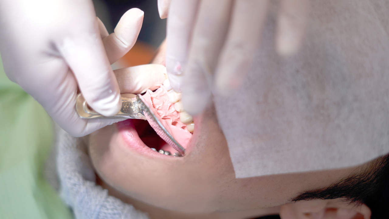 呉市中通の保険のノンクラスプデンチャー