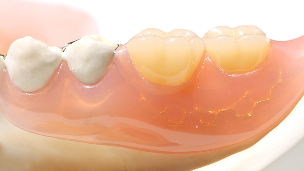 呉市中通の保険のノンクラスプデンチャー