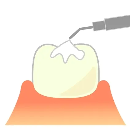 呉市中通のシーラント