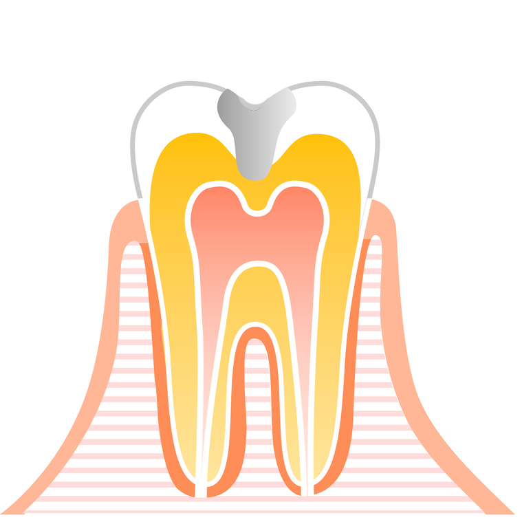 呉市中通のなるべく神経を残す治療
