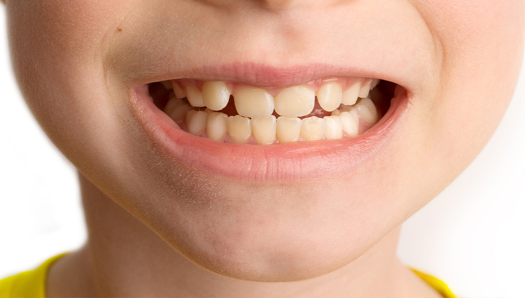 呉市中通の小児歯科治療