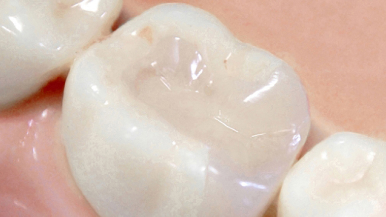 呉市中通のなるべく神経を残す治療