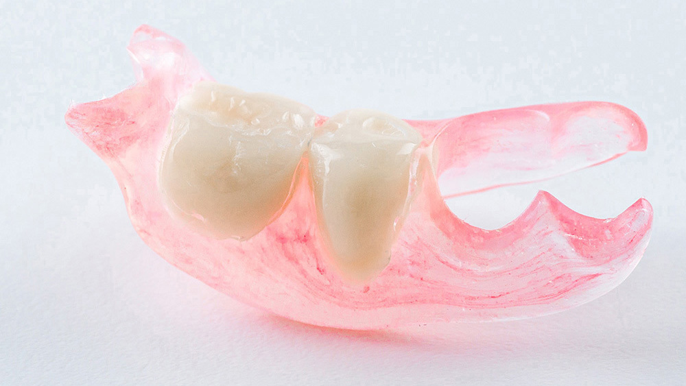 呉市中通の保険のノンクラスプデンチャー