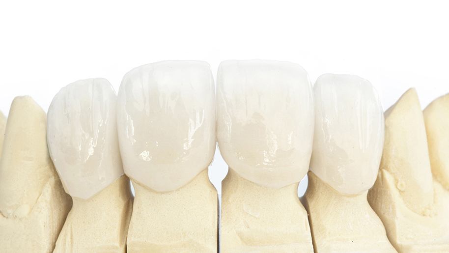 呉市中通のCAD/CAM（保険の白い詰め物・被せ物）