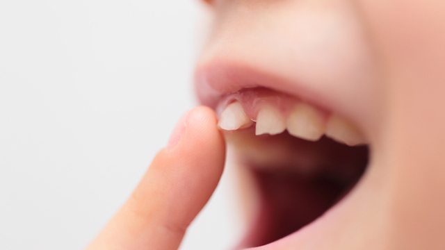 呉市中通の小児の予防歯科